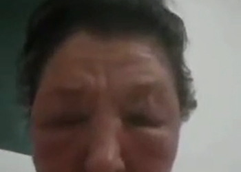 Woman get face disfigured after taking the AstraZeneca  Jab