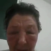 Woman get face disfigured after taking the AstraZeneca  Jab