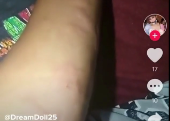 Moderna Vaccine side effect