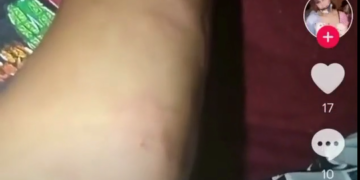 Moderna Vaccine side effect