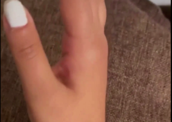 Neurological problems caused by the Pfizer vaccine