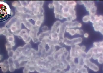 THE BLOOD OF A DOUBLE VACCINATED PATIENT   They knew this would be a problem, with 40 trillion mRNA molecules entering the circulatory system  and that the spike protein was intrinsically TOXIC