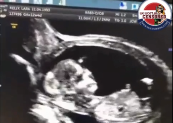 A young pregnant woman injects the second dose of the eugenic vaxx.  Three and a half weeks later, she goes to the hospital for doctors to check how the fetus is growing. They tell him that he is dead and that he has been dead inside his body for about three and a half weeks.