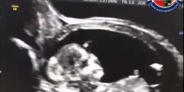 A young pregnant woman injects the second dose of the eugenic vaxx.  Three and a half weeks later, she goes to the hospital for doctors to check how the fetus is growing. They tell him that he is dead and that he has been dead inside his body for about three and a half weeks.