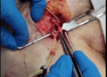 “This Is Not Normal” – Embalmer Richard Hirschman Releases Footage of Unbelievable Blood Clots