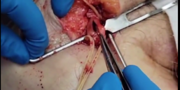 “This Is Not Normal” – Embalmer Richard Hirschman Releases Footage of Unbelievable Blood Clots