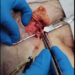 “This Is Not Normal” – Embalmer Richard Hirschman Releases Footage of Unbelievable Blood Clots